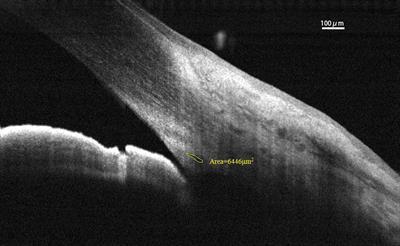 Age-Related Changes in Human Schlemm’s Canal: An in Vivo Optical Coherence Tomography-Based Study
